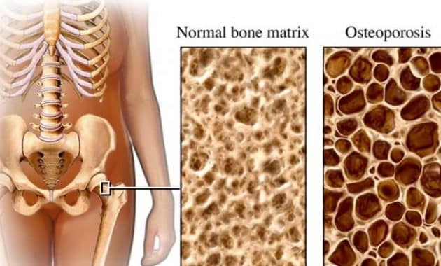 Jelaskan faktor penyebab terjadinya osteoporosis